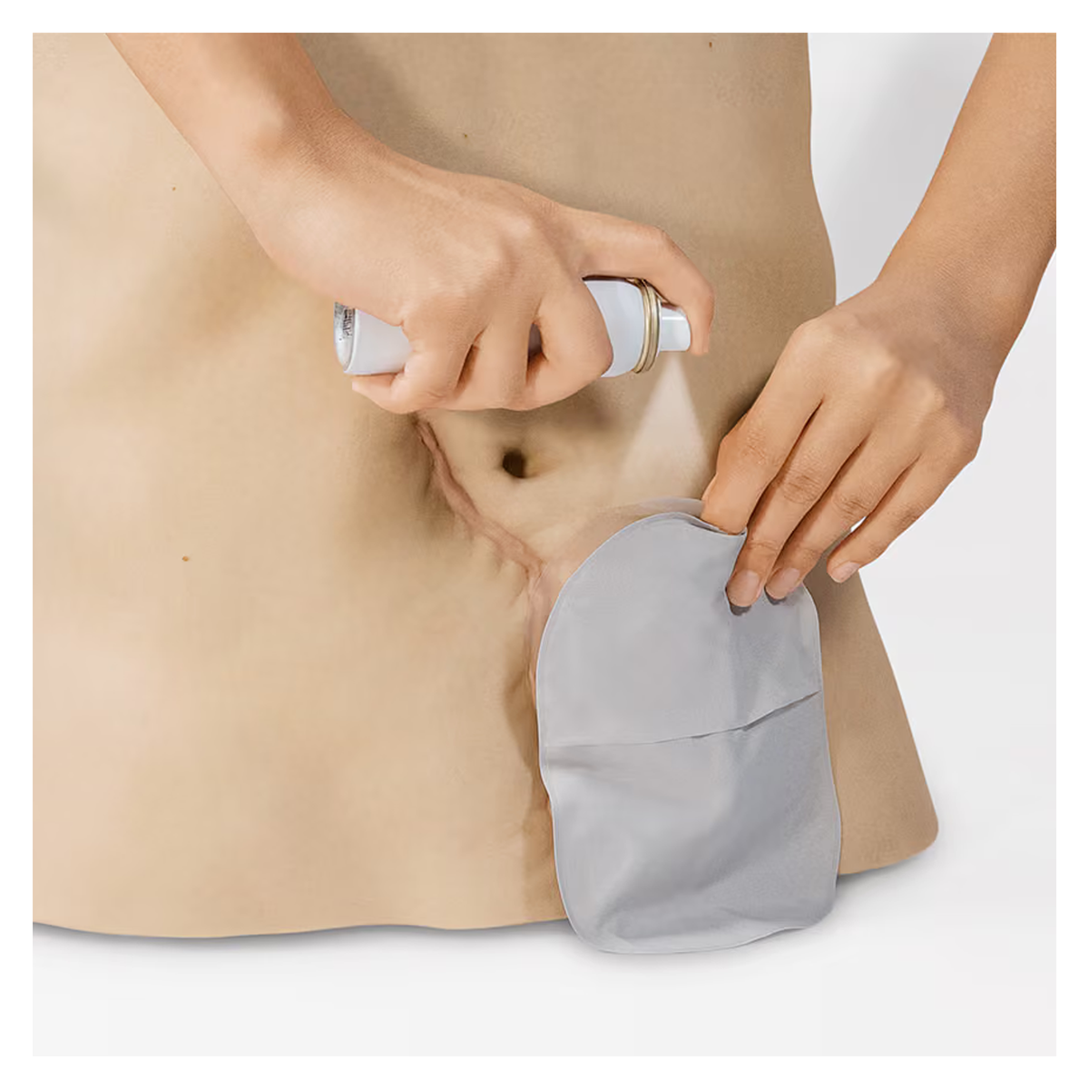 Applying Coloplast Brava Adhesive Remover Spray during an ostomy pouch change