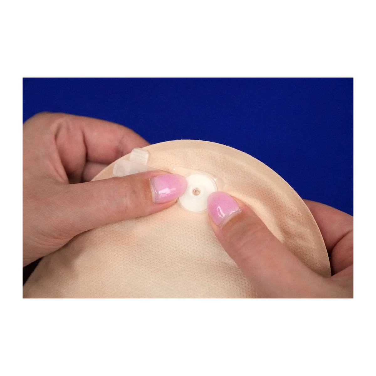 Attaching an Osto-EZ-Vent to an ostomy pouch